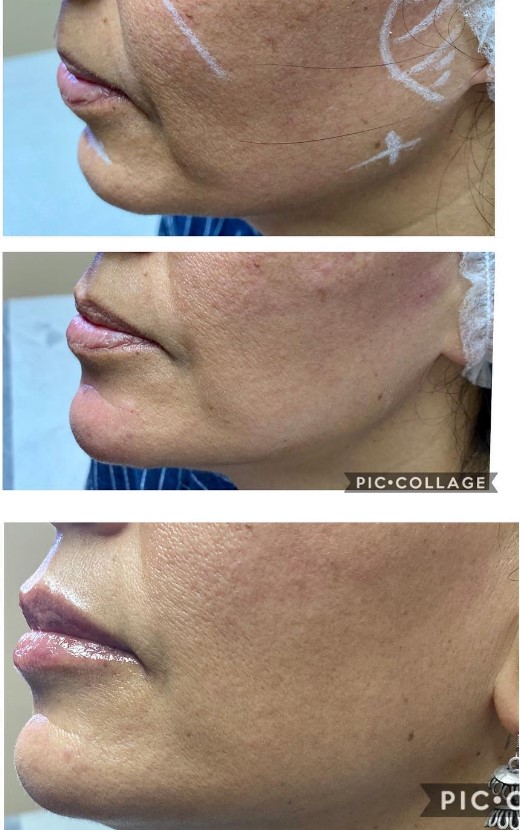 Prima e dopo il trattamento