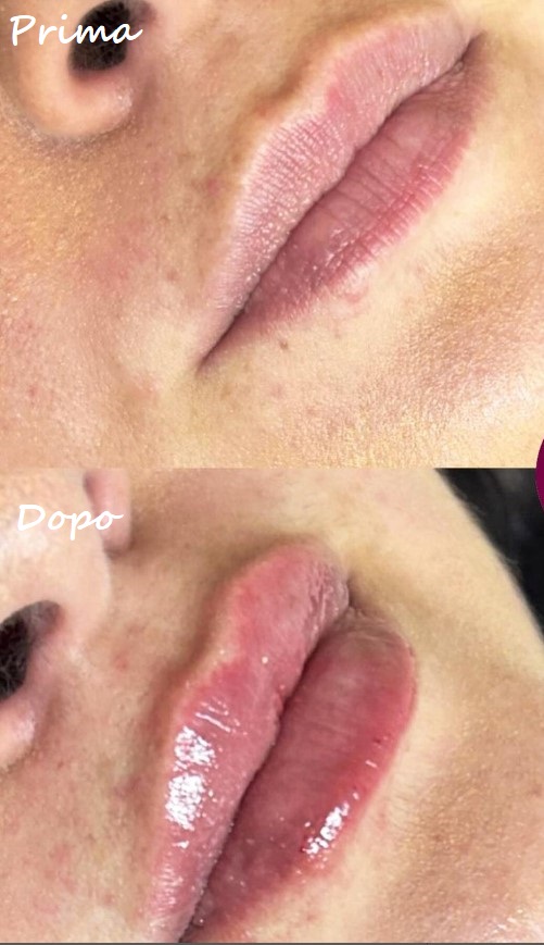 Prima e dopo il trattamento