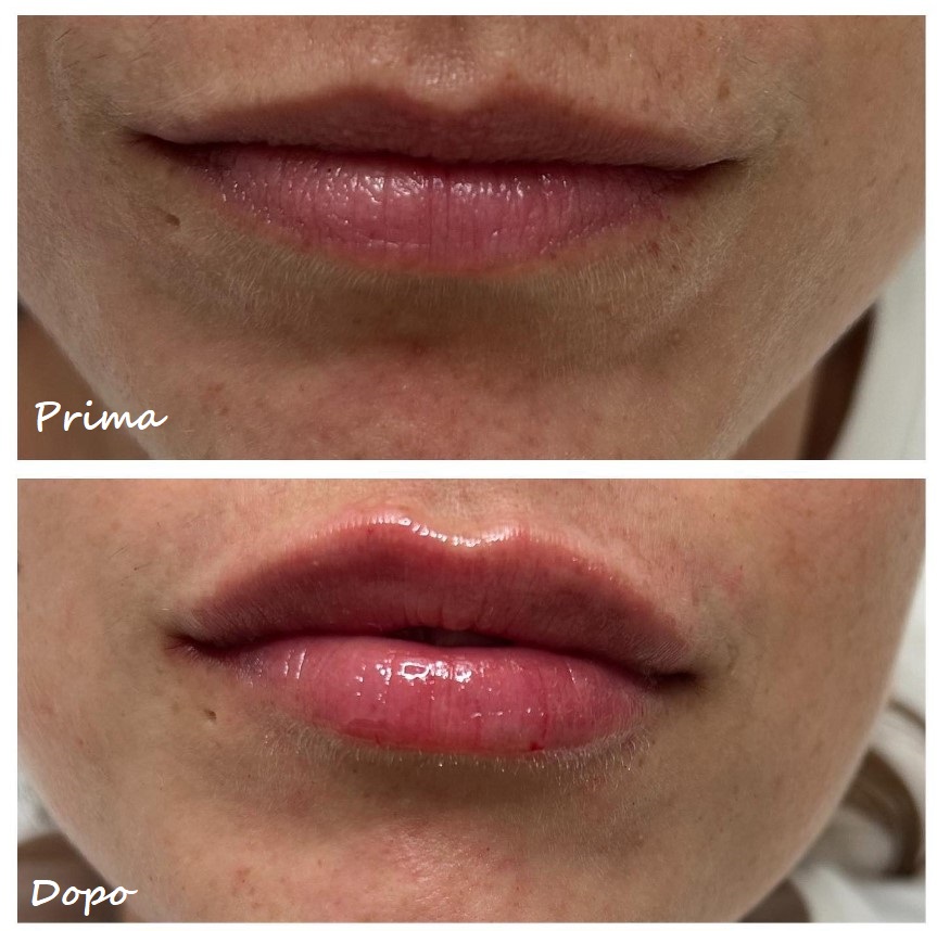 Prima e dopo il trattamento