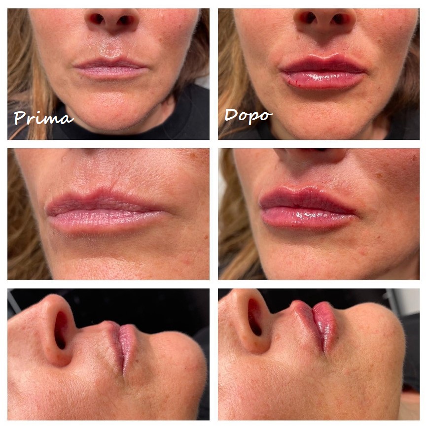 Prima e dopo il trattamento