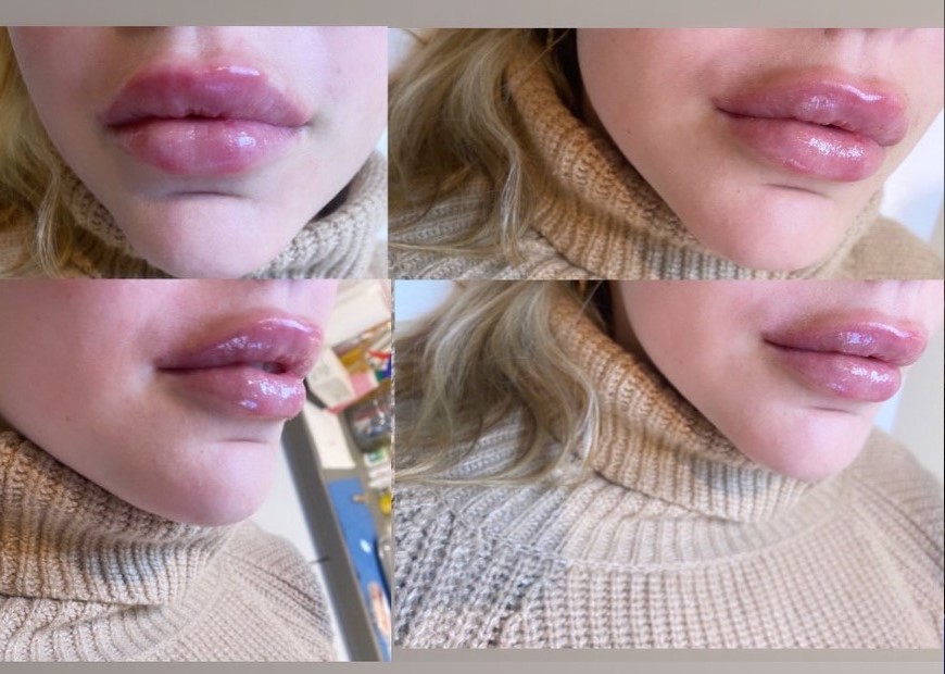 Prima e dopo il trattamento