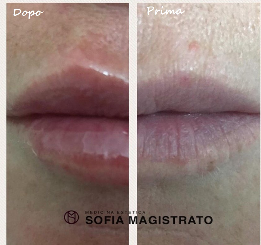 Prima e dopo il trattamento