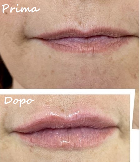 Prima e dopo il trattamento