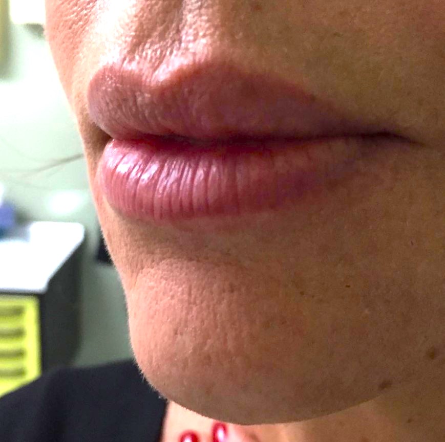 Prima e dopo il trattamento