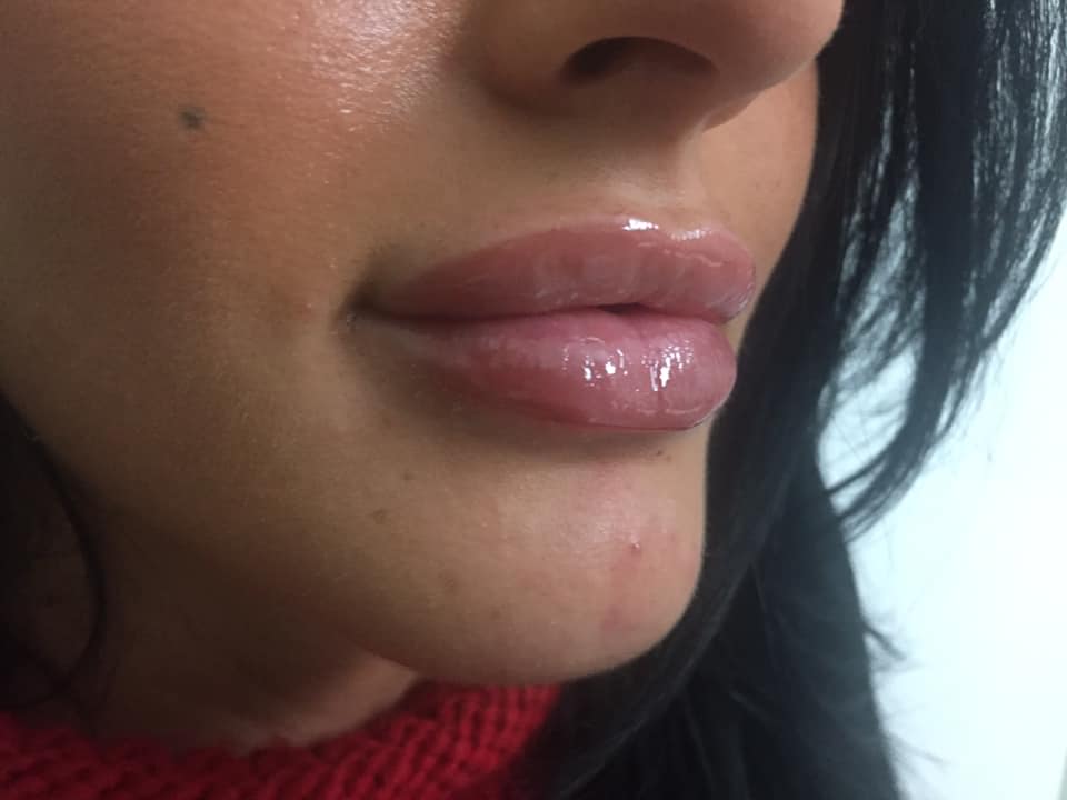 Prima e dopo il trattamento