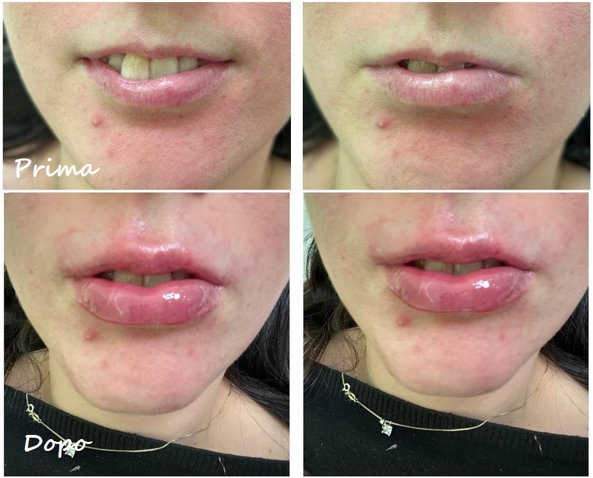 Prima e dopo il trattamento