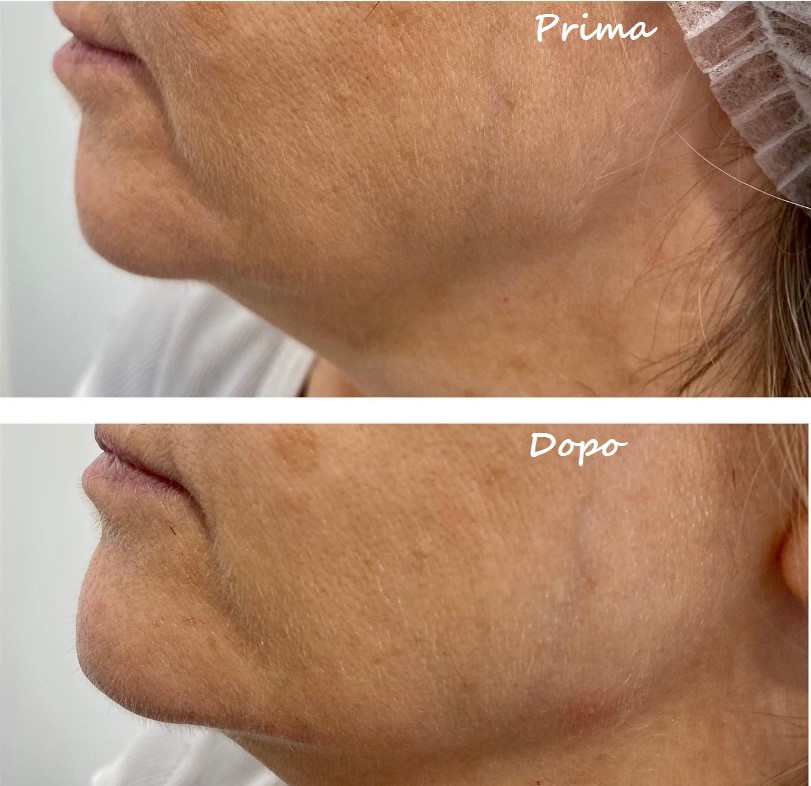 Prima e dopo il trattamento