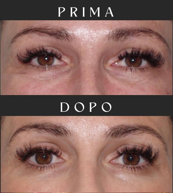 Prima e dopo il trattamento