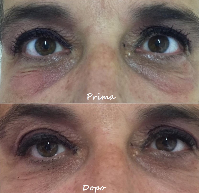 Prima e dopo il trattamento