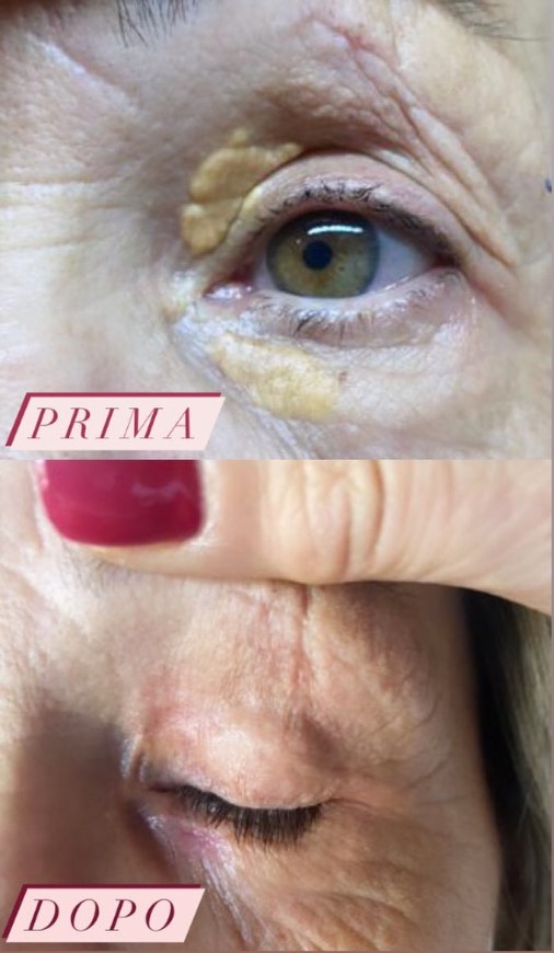 Prima e dopo il trattamento