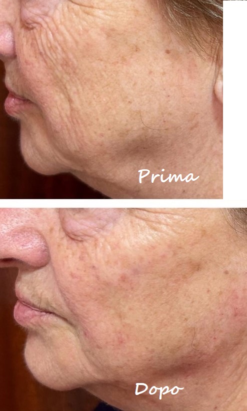 Prima e dopo il trattamento