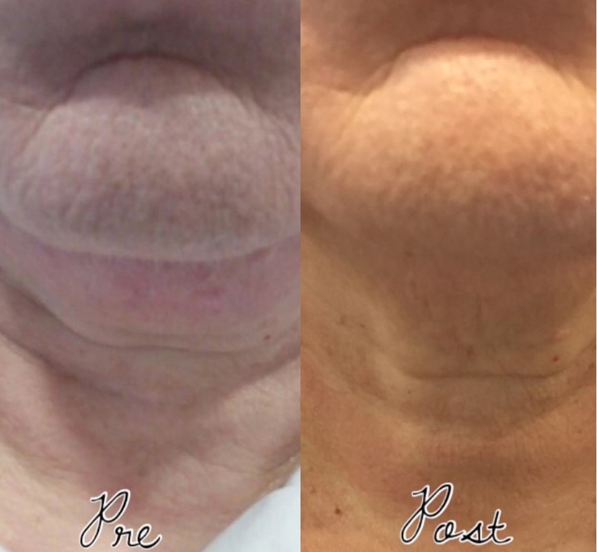 Prima e dopo il trattamento