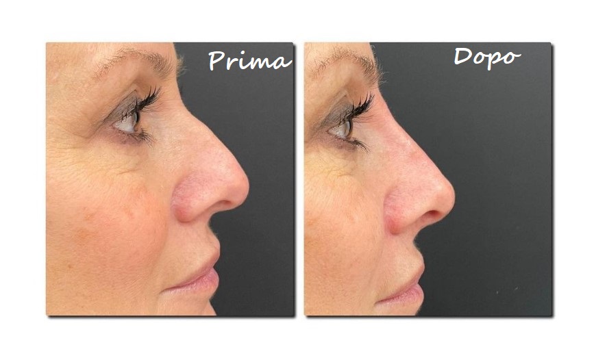 Prima e dopo il trattamento