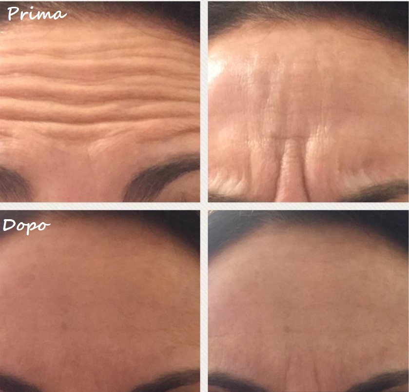 Prima e dopo il trattamento