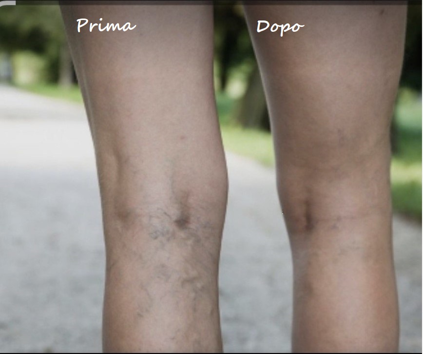 Prima e dopo il trattamento