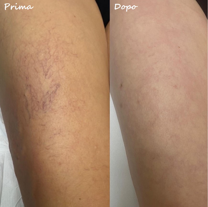 Prima e dopo il trattamento