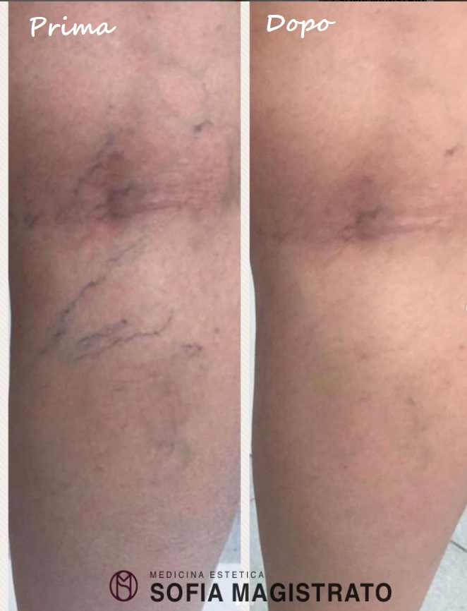 Prima e dopo il trattamento