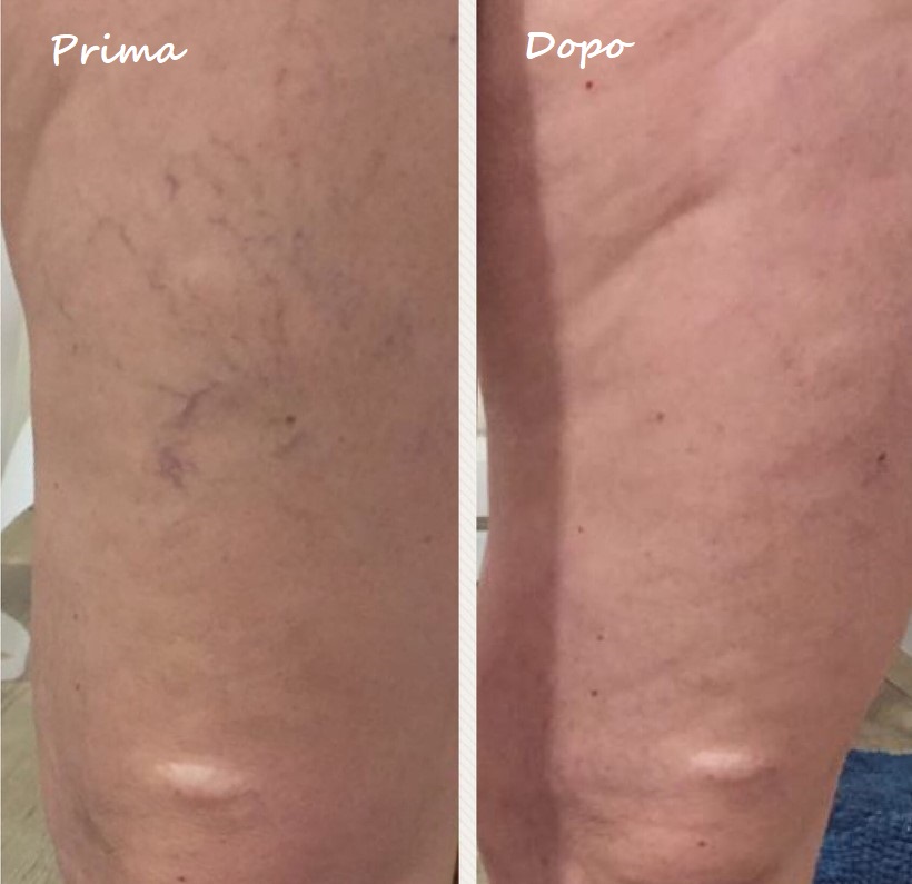 Prima e dopo il trattamento