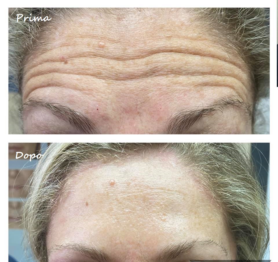 Prima e dopo il trattamento