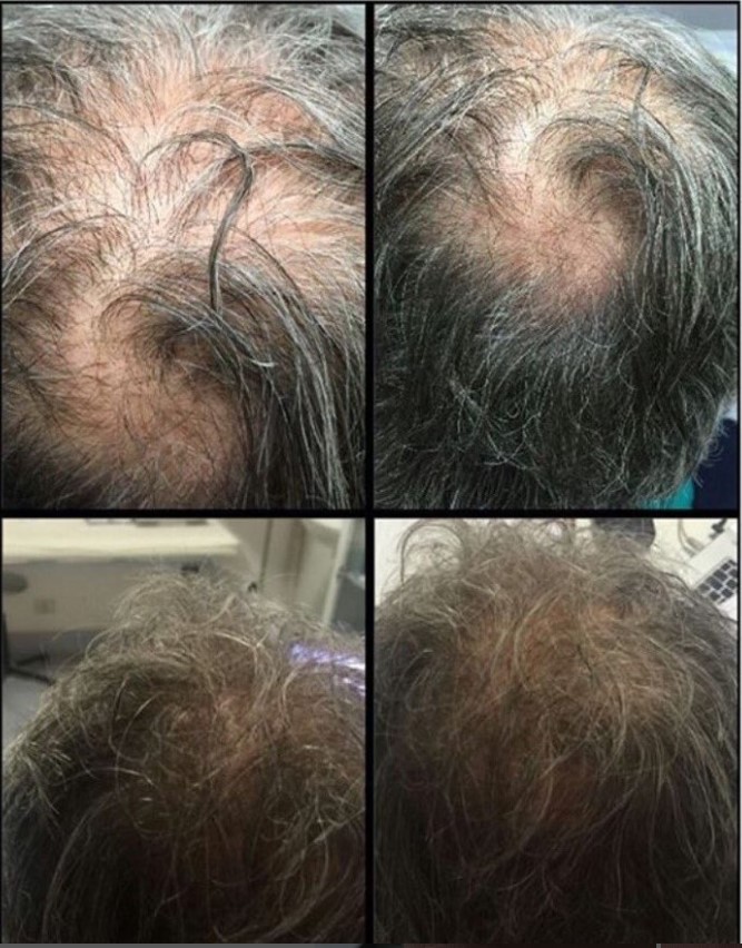 Prima e dopo il trattamento