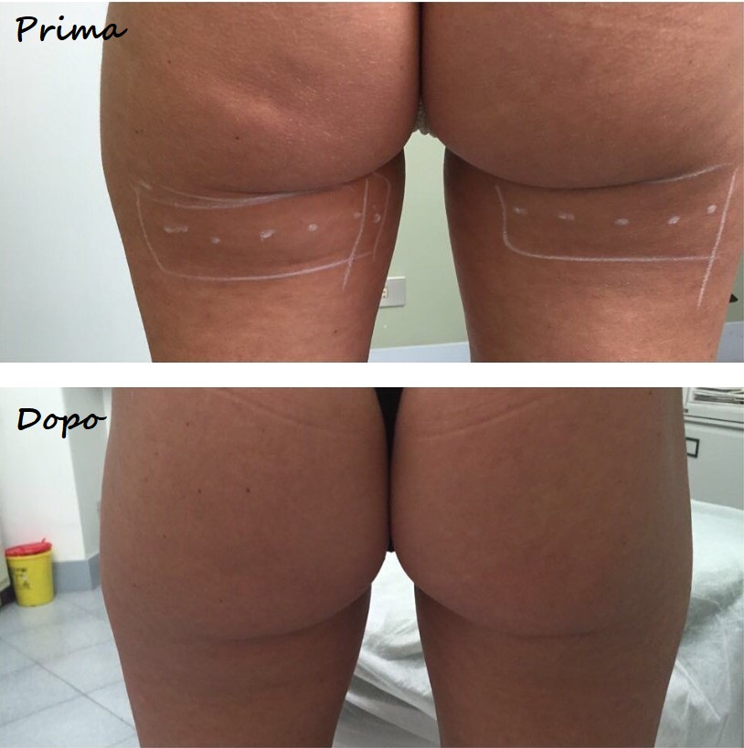 Prima e dopo il trattamento