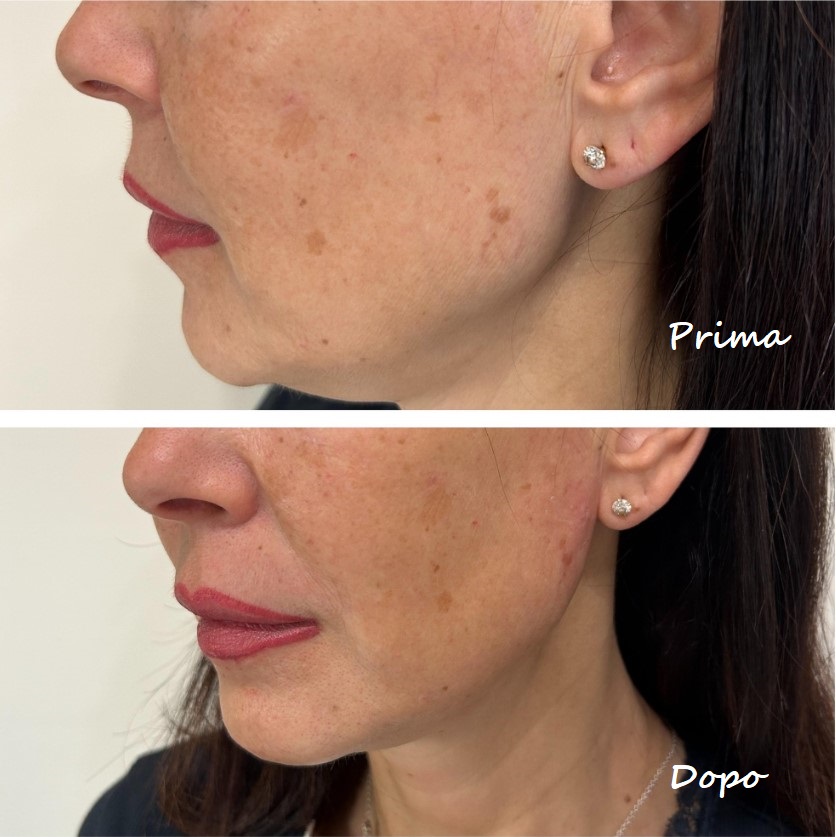 Prima e dopo il trattamento