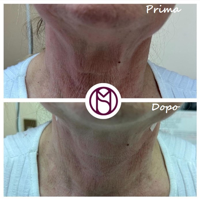Prima e dopo il trattamento