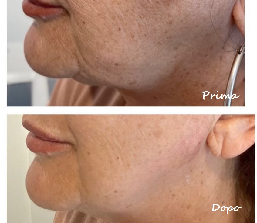 Prima e dopo il trattamento