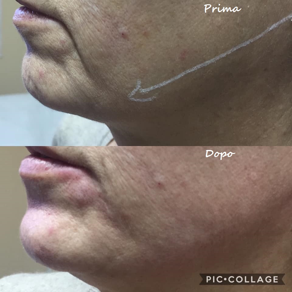 Prima e dopo il trattamento